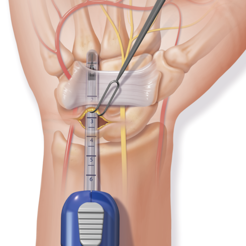 Endoscopic Carpal Tunnel Release John Riehl MD